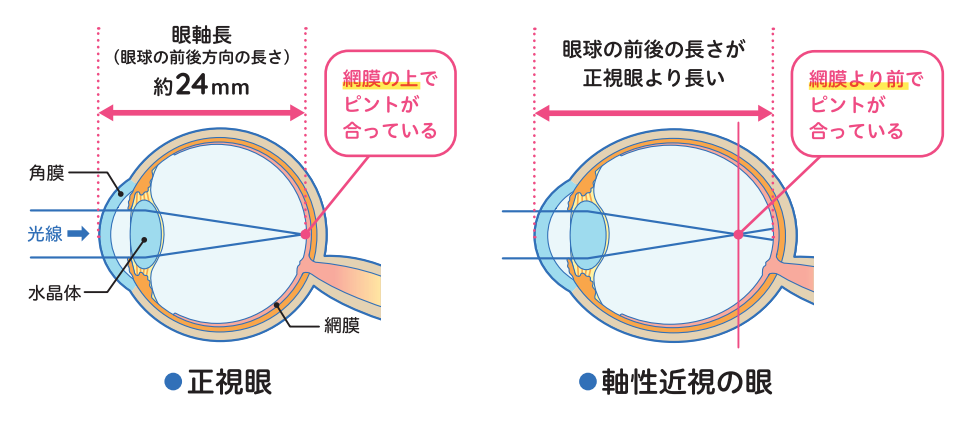 正常眼と近視眼の違い