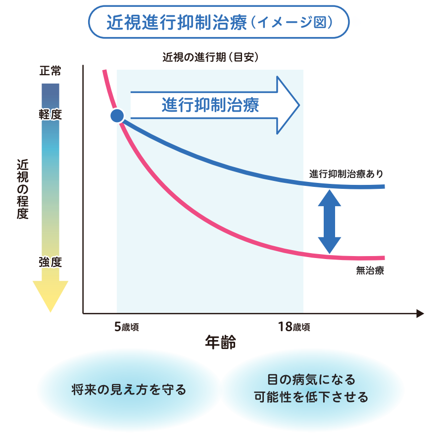 近視進行抑制治療のイメージ
